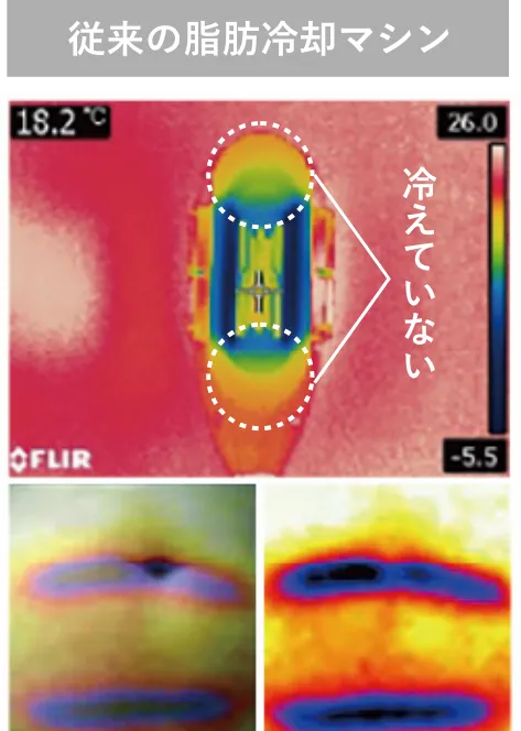 従来の脂肪冷却マシン