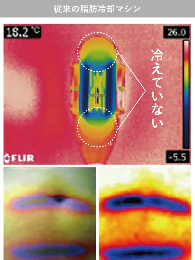 従来の脂肪冷却マシン